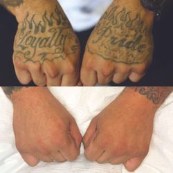 Removery Tattoo Removal & Fading
