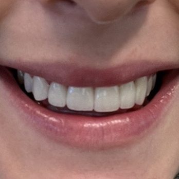 John M. Chaves, DDS - After, for 3 months of Invisalign and veneers - Cosmetic Dentists Near Me - Woodland Hills, California John M. Chaves, DDS - After, for 3 months of Invisalign and veneers - Cosmetic Dentists Near Me - Woodland Hills, California