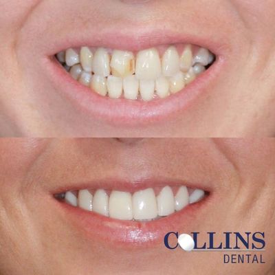 Veneers - Do you wish your smile looked different? Do you wonder what options you have? All of our doctors have extensive experience in cosmetic and implant dentistry.. Dr Mike helped this patient with new veneers and a bridge to match her existing smile, giving her a great new look!
Call us today to schedule your consultation, so you can get the smile of your dreams! 407-699-9831 Veneers - Do you wish your smile looked different? Do you wonder what options you have? All of our doctors have extensive experience in cosmetic and implant dentistry.. Dr Mike helped this patient with new veneers and a bridge to match her existing smile, giving her a great new look!
Call us today to schedule your consultation, so you can get the smile of your dreams! 407-699-9831