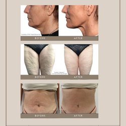 OndaPro has arrived! Stubborn fat, loose skin & cellulite -- treated with no downtime. Limited August intro pricing starts at $599.