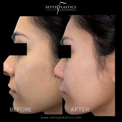 Setty Plastics and Aesthetics - Microneedling + Clear & Brilliant