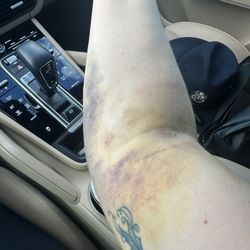 South Texas Blood And Tissue Center - Westover Hills Donor Room - Bruises from donation