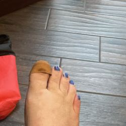 Sherman Nagler, DPM, FACFAS - My foot after surgery