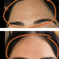 Botox of the forehead before and after