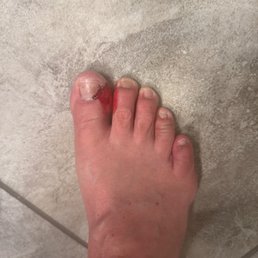 Mindy, ripped my right toes cuticle!! Bled and hurt for two weeks. Mindy, ripped my right toes cuticle!! Bled and hurt for two weeks.