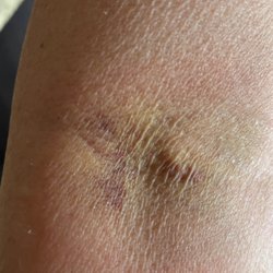 Quest Diagnostics - This was what my arm looked like 3 days after her blood draw.