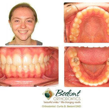 Bedont Orthodontics - 2) AFTER - Orthodontists Near Me - Camas, Washington