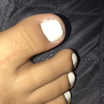 V Pedicure and Spa - You can see the pus and the terrible job done - Nail Salons Near Me - Gilroy, California