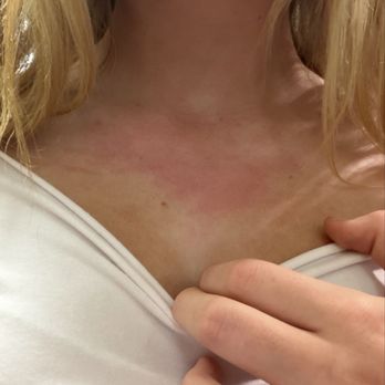 The Village Cafe - Reaction on Child After Contaminated Food - American Near Me - Winnetka, California