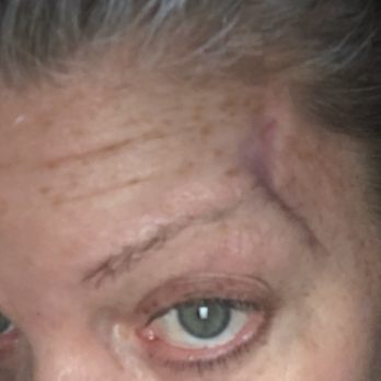 Ellebrow Microblading & Permanent Makeup Studio - BEFORE, left where I had 2 tumors removed. The scaring mangled my natural eyebrow - Permanent Makeup Near Me - New York, New York Ellebrow Microblading & Permanent Makeup Studio - BEFORE, left where I had 2 tumors removed. The scaring mangled my natural eyebrow - Permanent Makeup Near Me - New York, New York