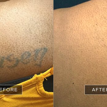 Removery Tattoo Removal & Fading - Tattoo Removal Near Me - Long Beach, California Removery Tattoo Removal & Fading - Tattoo Removal Near Me - Long Beach, California