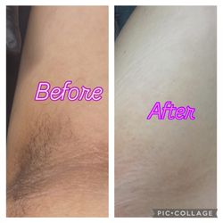 Under Arms Wax  Before and After