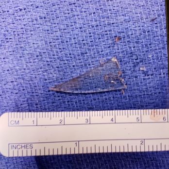 Pacific Orthopaedic Associates - This is the piece of glass he removed from my right hand , it was in my hand for three weeks unfortunately thanks to cov 19 - Physical Therapy Near Me - Alhambra, California Pacific Orthopaedic Associates - This is the piece of glass he removed from my right hand , it was in my hand for three weeks unfortunately thanks to cov 19 - Physical Therapy Near Me - Alhambra, California