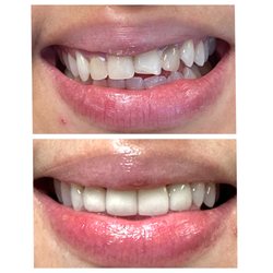 Capitol Dental - Before and After 4 crowns !
