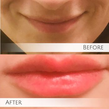 SkinDesigner Clinic - Lip Filler Special Every Month. - Medical Spas Near Me - Caldwell, New Jersey SkinDesigner Clinic - Lip Filler Special Every Month. - Medical Spas Near Me - Caldwell, New Jersey