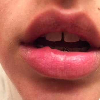 Midtown Dental Associates - Lip wounded while my teeth were being spaced. - General Dentistry Near Me - Austin, Texas Midtown Dental Associates - Lip wounded while my teeth were being spaced. - General Dentistry Near Me - Austin, Texas