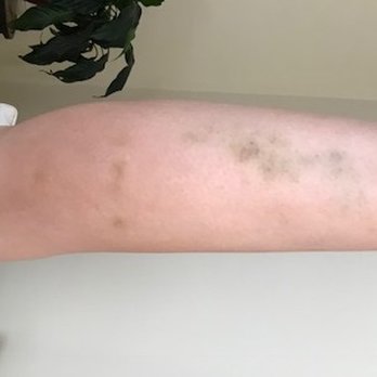 Allure Nails - ALL this bruising was from a pedicure. Beyond awful. - Nail Salons Near Me - Scottsdale, Arizona