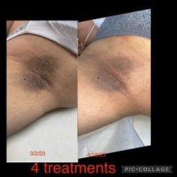 Beach Please - Skin lightening, before on left, after on right. 4 sessions between dates listed