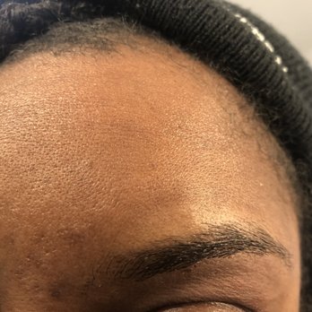 Angled Eyebrow Threading - The aftermath. The cut is right under my left brow. - Threading Services Near Me - Fontana, California