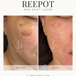 K Beauty Lab - REEPOT Age Spot Laser | Pigmentation Removal Before & After