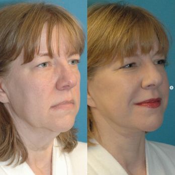 Sound Plastic Surgery - Facelift Surgery with Sound Plastic Surgery - Cosmetic Surgeons Near Me - Seattle, Washington