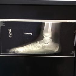Maria Steelman, MD - Small foot fracture :(