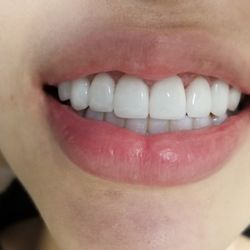Just Dental - After 8 units anterior crown