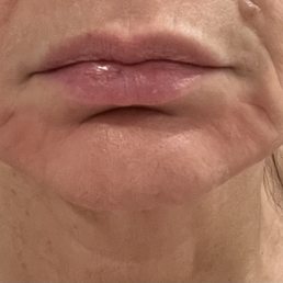 Before micro-needling Before micro-needling