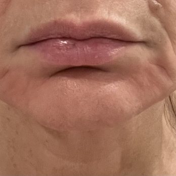 Glow Aesthetic Center - Before micro-needling - Medical Spas Near Me - Thousand Oaks, California Glow Aesthetic Center - Before micro-needling - Medical Spas Near Me - Thousand Oaks, California