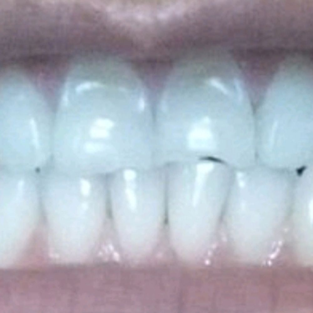 Glendora Dental - Before bonding - Cosmetic Dentists Near Me - Glendora, California Glendora Dental - Before bonding - Cosmetic Dentists Near Me - Glendora, California