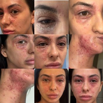 Thomas Dermatology - Staph infections from taking Rinvoq for TWO WEEKS. - Dermatologists Near Me - Las Vegas, Nevada