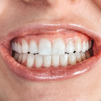 Kumra Orthodontics - End results - Orthodontists Near Me - Washington, DC, District of Columbia Kumra Orthodontics - End results - Orthodontists Near Me - Washington, DC, District of Columbia