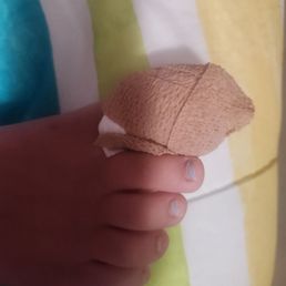 My baby's toe wrapped My baby's toe wrapped