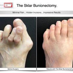Foot First Podiatry Center PC - Get a facelift for your feet with our unique bunion procedure, the Sklar Bunionectomy. Visit www.footfirst.com for more information.