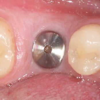 O'Neal Dentistry - Before Picture of a patient of Dr. O'Neal's that received an implant to replace a missing tooth. - General Dentistry Near Me - Tyler, Texas O'Neal Dentistry - Before Picture of a patient of Dr. O'Neal's that received an implant to replace a missing tooth. - General Dentistry Near Me - Tyler, Texas