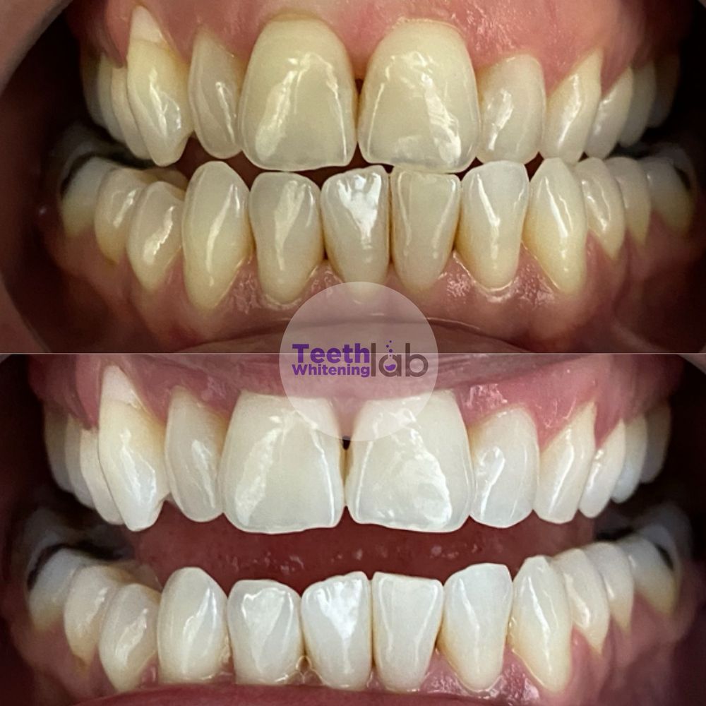 TOP 10 BEST Zoom Teeth Whitening in Torrance, CA - Updated 2026 - Yelp