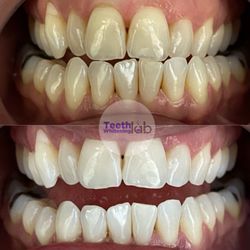 Teeth Whitening Lab  - Results compared to Zoom Teeth Whitening, but better. Zero to absolutely no sensitivity whatsoever.