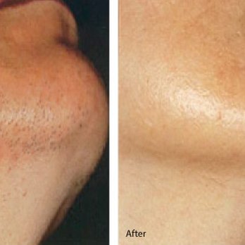 Lightning Electrolysis - Befoe and after - Hair Removal Near Me - Brooklyn, New York Lightning Electrolysis - Befoe and after - Hair Removal Near Me - Brooklyn, New York