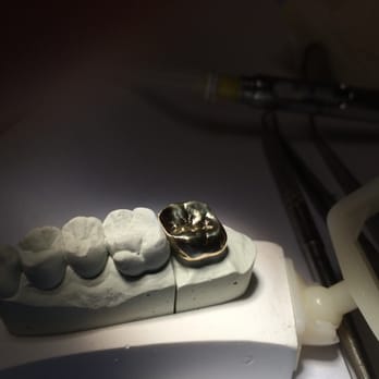 Cheng Dental - My gold crown - General Dentistry Near Me - San Gabriel, California Cheng Dental - My gold crown - General Dentistry Near Me - San Gabriel, California