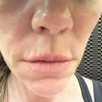 StudioMD - So lumpy! I've cried 2 times already. - Laser Hair Removal Near Me - New York, New York