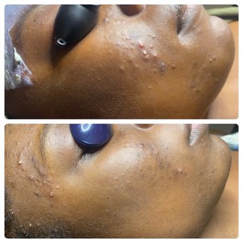 512 Skincare  - After one session with my hormonal acne - Skin Care Near Me - Austin, Texas