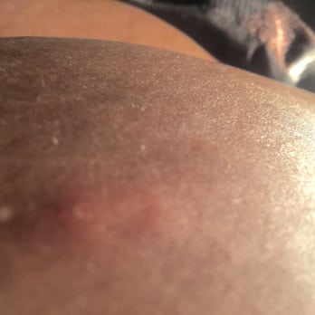 La Quinta by Wyndham Mansfield TX - Bug bite - Hotels Near Me - Mansfield, Texas