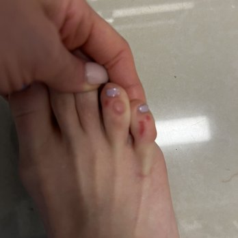 A Paris Nail Bar - Day after pedicure from callus removal - Nail Salons Near Me - Boca Raton, Florida A Paris Nail Bar - Day after pedicure from callus removal - Nail Salons Near Me - Boca Raton, Florida