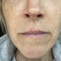 Paul N Afrooz, MD - Tip cartilage too large making skin white