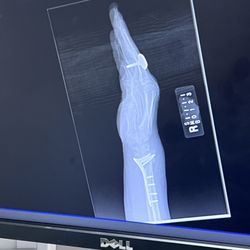 Rama Pathi, MD - Current x-ray of HOW MY WRIST SHOULD LOOK!