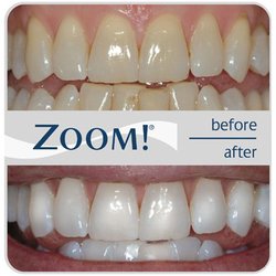 El Camino Dental - Original Zoom! In-office Whitening!
Call us (424) 297-0513