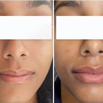 Chic Beauty Bar - Lip augmentation - Eyebrow Services Near Me - Edgewater, New Jersey Chic Beauty Bar - Lip augmentation - Eyebrow Services Near Me - Edgewater, New Jersey