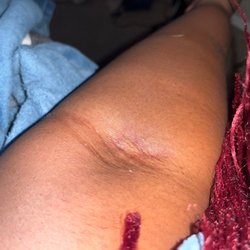 HonorHealth Mountain Vista Medical Center - More bruises