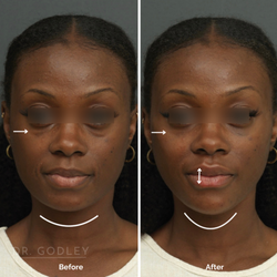 Godley Clinic - Filler and thread lift combo to address under-eye bags, lip asymmetry and jaw definition.