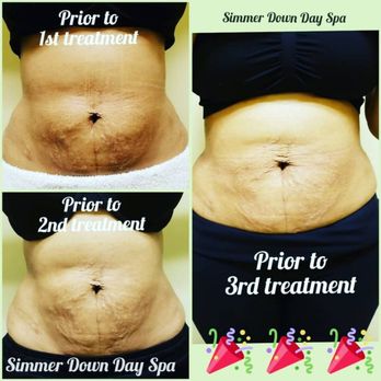 Simmer Down Day Spa - Radio Frequency Skin Tightening! This is after two, 25 minute sessikns! - Skin Care Near Me - Riverside, California Simmer Down Day Spa - Radio Frequency Skin Tightening! This is after two, 25 minute sessikns! - Skin Care Near Me - Riverside, California